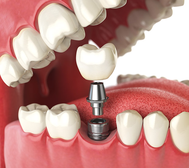 San Diego Will I Need a Bone Graft for Dental Implants