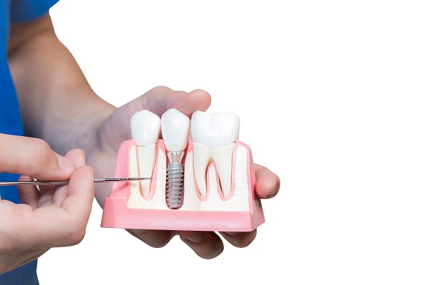 A Periodontist Explains The Process And Visits For Getting Dental Implants