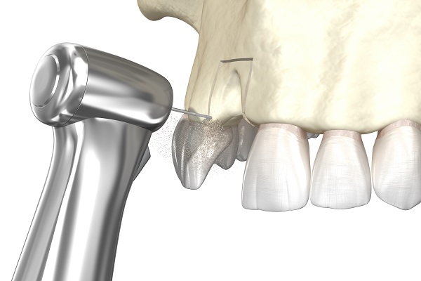 Five Tips For Gum Graft Recovery