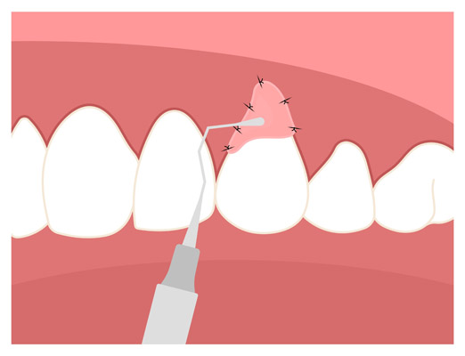 Exploring Gum Grafting Techniques