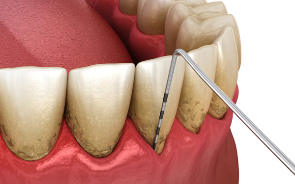 Gum Recession Treatment From A Periodontist