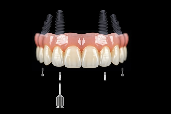 Why Choose Implant Supported Dentures? Top Benefits Explained