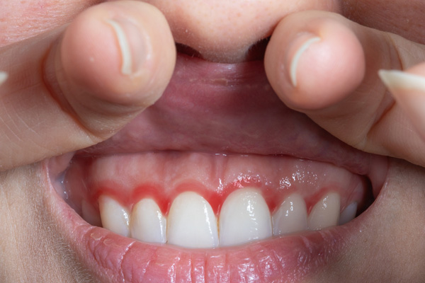 How A Periodontist Can Help With Receding Gums