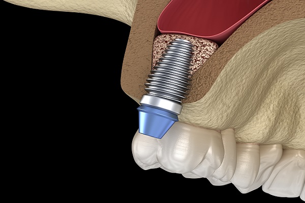 Sinus Lift Procedure And Dental Implants