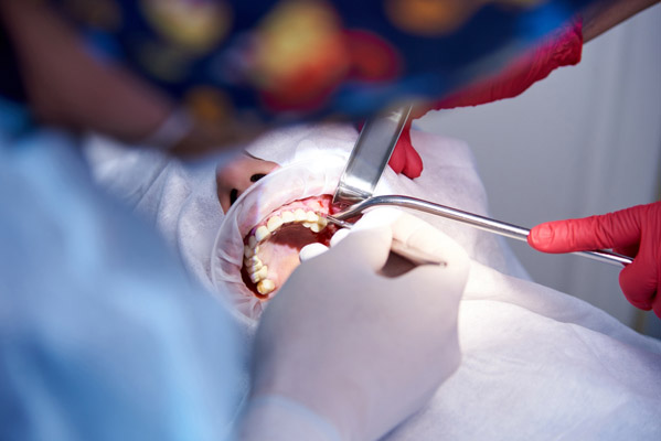 What Is A Popular Technique For A Sinus Lift Procedure?